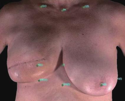 Currently, the most commonly performed breast reconstruction is two-stage expander-implant reconstruction [14]. One of the central features of breast reconstruction aesthetics is breast projection.