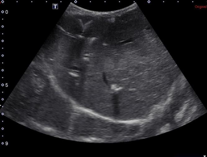 Abdominal Ultrasound: o Findings Moderately