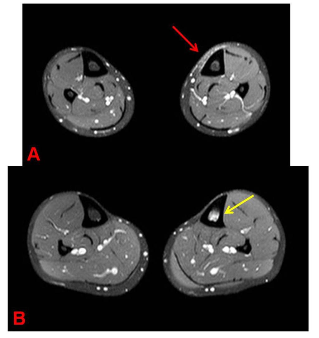 Fig. 7: A. Axial fat-suppressed T2-weighted fast spin-echo image shows mild periosteal edema (red arrow) on medial cortex of the left tibia B.