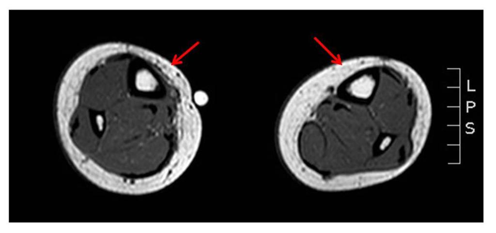 Fig. 3: Axial T1-weighted fast spin-echo image.