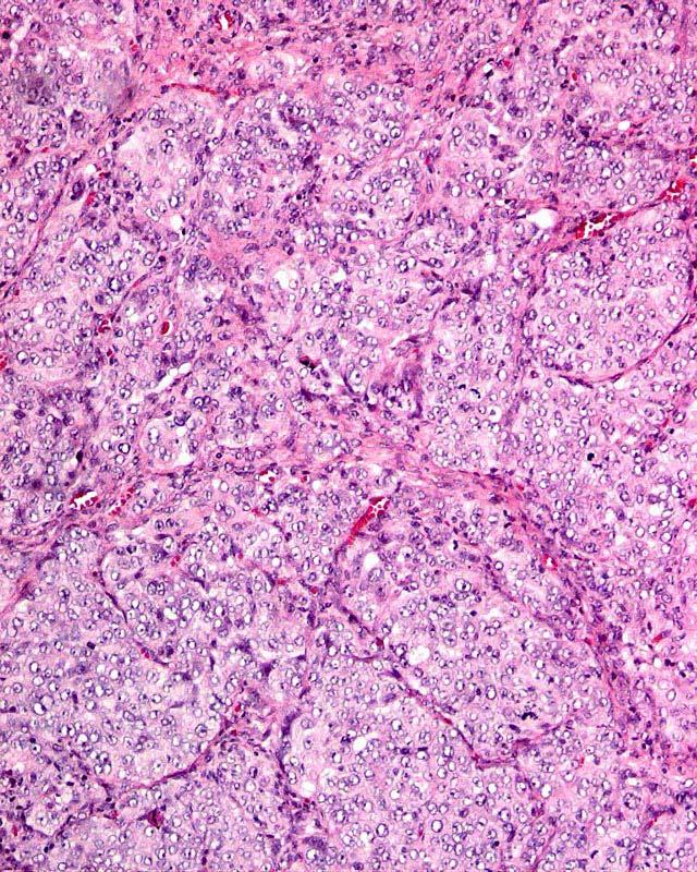 Undifferentiated Carcinoma By definition a high grade carcinoma The 5-year survival of patients with