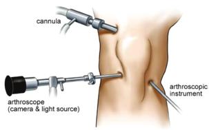 SUMMARY OF PROCEDURE Arthroscopy involves looking at the inside of the knee joint with a small telescope and camera (arthroscope).