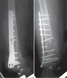Retrograde Nailing for Nonunions of Femoral Supracondylar Fractures Fig. 1. Radiograph in case 1 shows nonunion, loss of fixation, and breakage of proximal and distal screws.