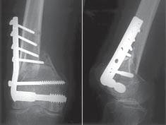 A tibial Russell-Taylor intramedullary nail (Smith and Nephew Richard, Memphis, TN, USA) was inserted with a retrograde intramedullary nailing technique through the intercondylar notch.
