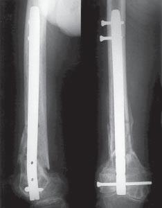 However, the postoperative course was complicated by persistent pain and stiffness of the knee joint.