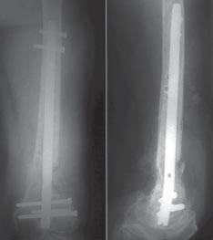 J.L. Pao and C.C. Jiang Fig. 4. Final radiographs in case 2 reveal union of the fracture. A large amount of callus could be found around the fracture site.