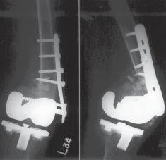 TKA (cruciate retaining, MGII; Zimmer, Warsaw, Indiana) had been performed on the ipsilateral knee for severe rheumatoid arthritis 4 years before the accident.