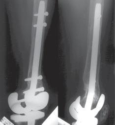 Retrograde Nailing for Nonunions of Femoral Supracondylar Fractures Fig. 7. Final radiographs in case 3 reveal solid union of the nonunion above the total knee femoral component.