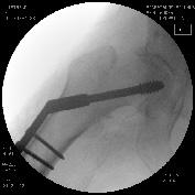 Example of performed surgery with PinTrace Femoral fracture (IM-nailed) Ankle Arthrodesis Robot guided saw template for knee prosthesis Orthopedic surgery with PinTrace The principal aim of