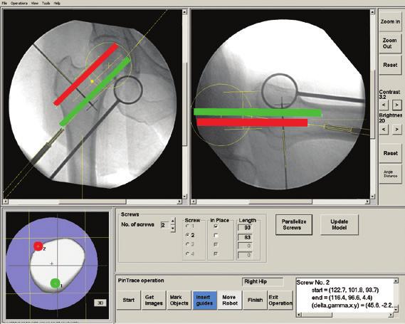 PinTrace with input from two-dimensional C-arm The picture shows a simulation of an incorrectly placed fixation site not visible on the X-ray images, but clear in the crosssectional graph (see