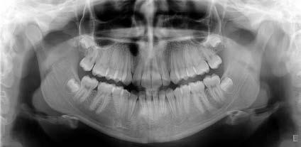 image layer. The V-shaped X-ray beam also allows for more penetrating power for the thicker maxilla area.