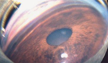 These are known as PPSC Posterior Polar Subcapsular Cataracts). In the Samoyed, onset is usually at by 2-3 years. Fortunately due to diligence of the many good breeders, the incidence is now very low.