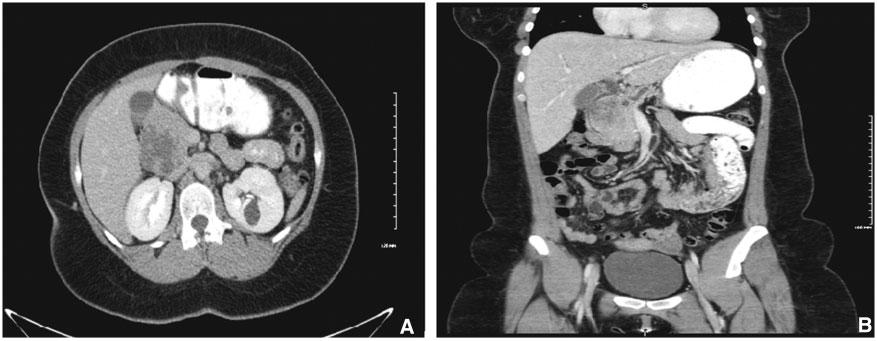 Solid pseudopapillary tumor Figure 2. CT Abdomen and Pelvis (A) with and (B) without contrast showing pancreatic mass. Figure 3.