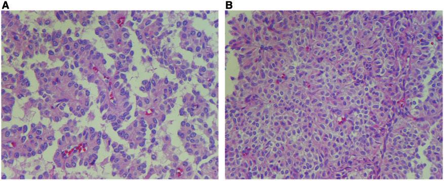 nuclear positive staining for beta catenin; (F) alpha 1 anti-trypsin stain positive. Figure 5. Histopathology revealing: (A) pseudopapillary cores; (B) solid, highly vascular architecture.
