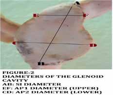 In the present study, by studying the dried Human scapulae the average measurements and incidence of different shapes of Glenoid cavity of south Indian population has been reported.