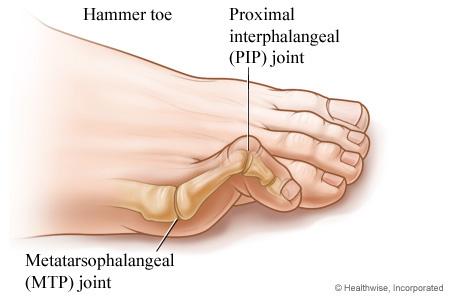 A hammer toe occurs when a toe (usually the second toe) bends down at the middle toe joint (proximal interphalangeal joint,