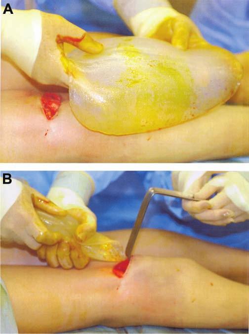 (This patient s preoperative and postoperative photographs can be seen in Figure 5.
