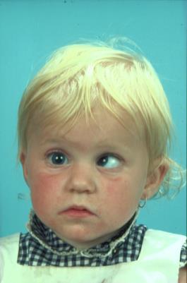 Infantile Esotropia Not truly congenital Onset usually between four and six months of age Typically have moderate to