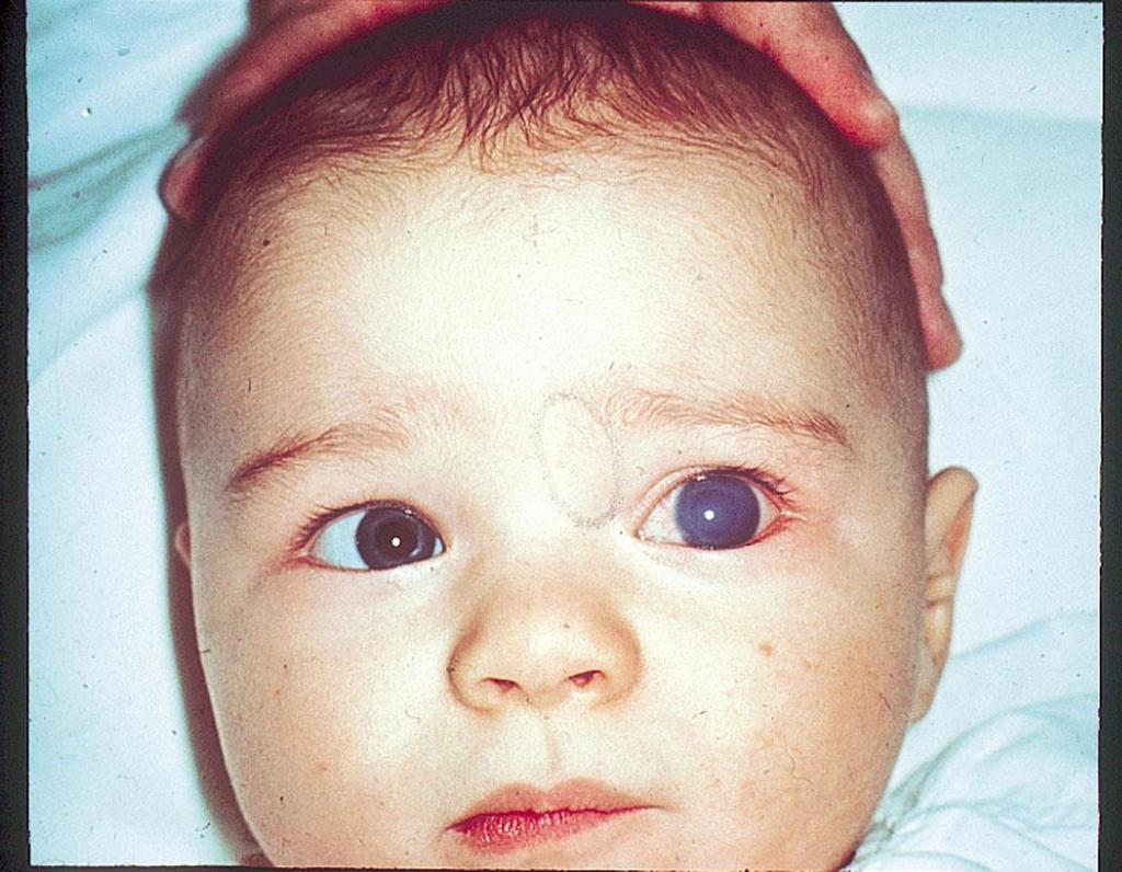 Infantile Glaucoma Affects 1/8-10,000 children (M East 1/2,500) Primary congenital glaucoma usually