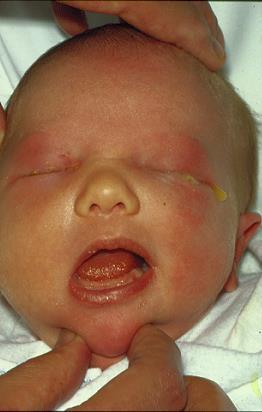 Ophthalmia neonatorum Any severe conjunctivitis in the newborn period Bacterial - N Gonorrhoeae