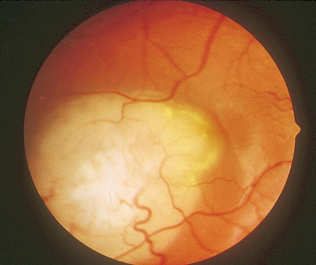 Retinoblastoma Malignant eye cancer 1/18,000 live births Often results in loss