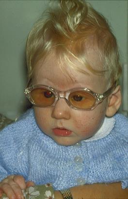 Child with Poor Vision Acute intervention (PLVC) Mobility Low Vision