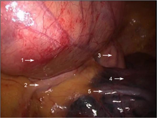 Li and Wang World Journal of Surgical Oncology 2014, 12:398 Figure 3 Intraoperative image of a huge solid thymoma located at the left side anterior mediastinum.