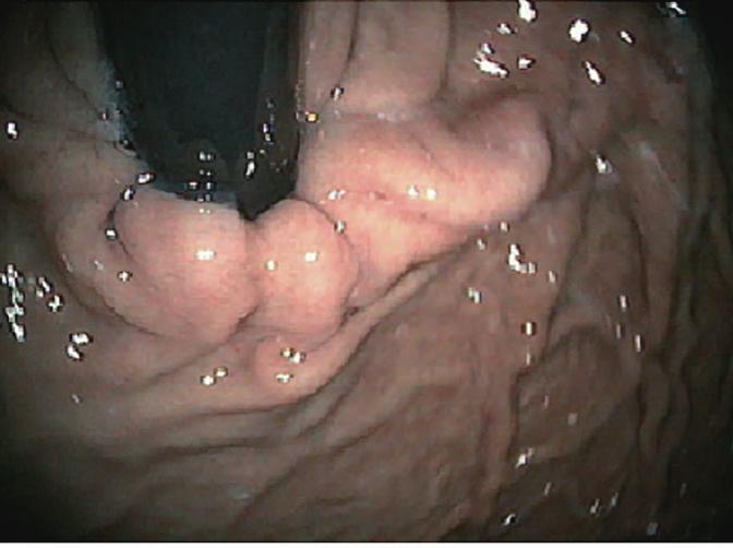 0 cm) (A) and long segment columnar lined esophagus (4.0 cm) (B).