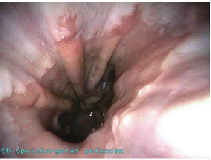 endoscopic image towards the esophagogastric junction 2