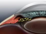 01 mm /year Medical Retina Firm, June 2008 POAG GLAUCOMA JOAG 1 0 Developmental PDS 2 0 (PXF) Episcleral Venous Pressure
