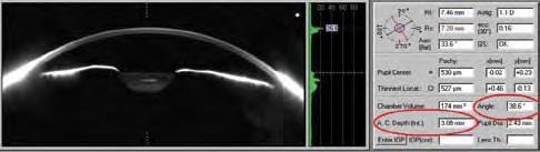 Anterior chamber Imaging Ultrasound Biomicroscopy (UBM) Ultrasound based pizoelectric probe Tissue penetration of 5mm