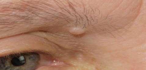 Non-papillomatous dermal naevus: (Miescher) Dome-shaped nodule on face Skin