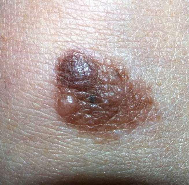 melanoma?