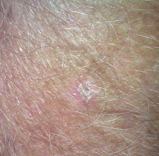 scabies?