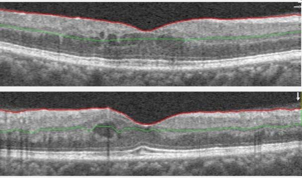 The color fundus photograph in this case indicates background diabetic retinopathy.