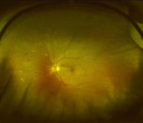 The hard exudates, microaneurysms, and cotton wool spots on this color fundus photograph indicate diabetic retinopathy.