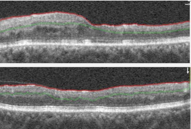 The OCTA images of the superficial capillary plexus and the deep capillary plexus reveal severe ischemia and swaths of capillary dropout (white arrows), especially on the temporal aspect of the fovea.