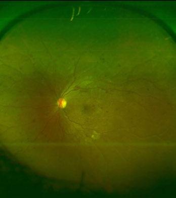inner retina and thinning of the retina associated with the areas that have profound ischemia.
