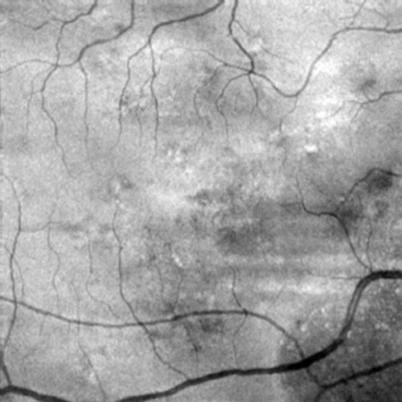 Choroidal Neovascularization Case 1 Images courtesy of Julie Rodman, OD CHOROIDAL NEOVASCULARIZATION In this case, the color fundus photograph shows pigment changes in the macula, and the OCT B-scan