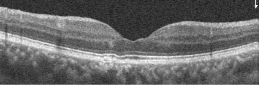 Of the four automatically generated OCTA segmentation maps provided in the overview report, the two of most interest for evaluating choroidal neovascularization (CNV) are the slabs showing the