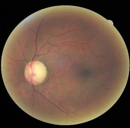 However, clinicians must be aware that projection artifact from the superficial retinal vasculature, or larger choroidal vessels that have been displaced into an area of atrophy can masquerade as CNV.