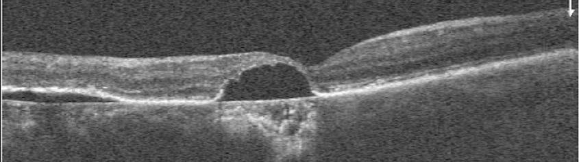 As with the previous patient, look carefully for any subretinal fluid, and refer to a retinal specialist.