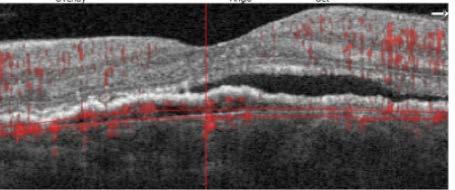 The pigment loss, nasal to the fovea, may indicate an area of atrophy or a pigment epithelial detachment.