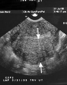 Adenomyosis- AUB-A Endometrial tissue within muscle of uterus, 5-60% prevalence Used to be called endometriosis interna, no longer under one disease entity. Unknown etiology.