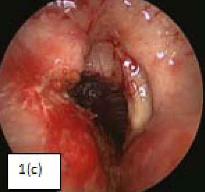 created airway created intraoperatively is shown in Figure 1(c). Postoperative antibiotics and proton pump inhibitor were not given routinely in this series.