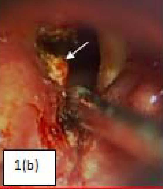 Original Article Laser Posterior Cordotomy for Bilateral Vocal Fold Immobility Figure 1(b): A triangular shaped area posterior to the incision was ablated Figure 1(c): Endoscopic view of the larynx