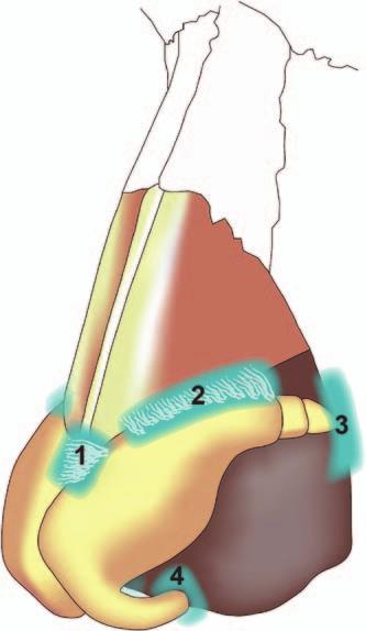 Volume 134, Number 1 Decreasing Nasal Tip Projection a cause nevertheless. On rare occasion, the spine may need to be carefully reduced and the septum seated farther posterior.