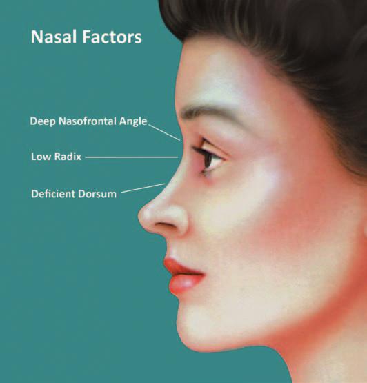 Plastic and Reconstructive Surgery July 2014 Fig. 4. Nasal factors that give the illusion of an overprojected nose. Fig. 3.