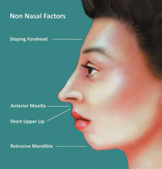 Deviation from normal ideals of facial proportions or subunits may erroneously produce the illusion of nasal overprojection.