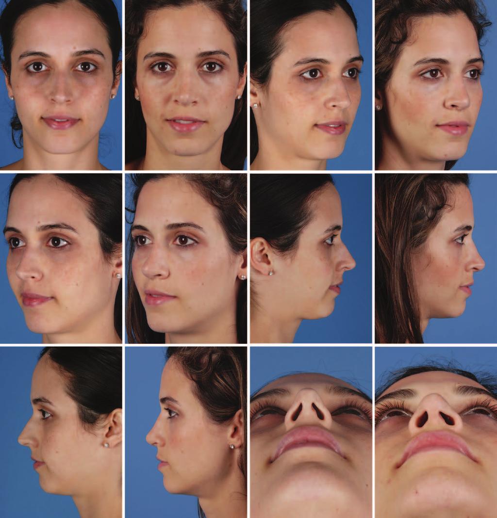 Plastic and Reconstructive Surgery July 2014 Fig. 7. Case example of a 28-year-old woman undergoing primary rhinoplasty. Postoperative results are at 1 year.